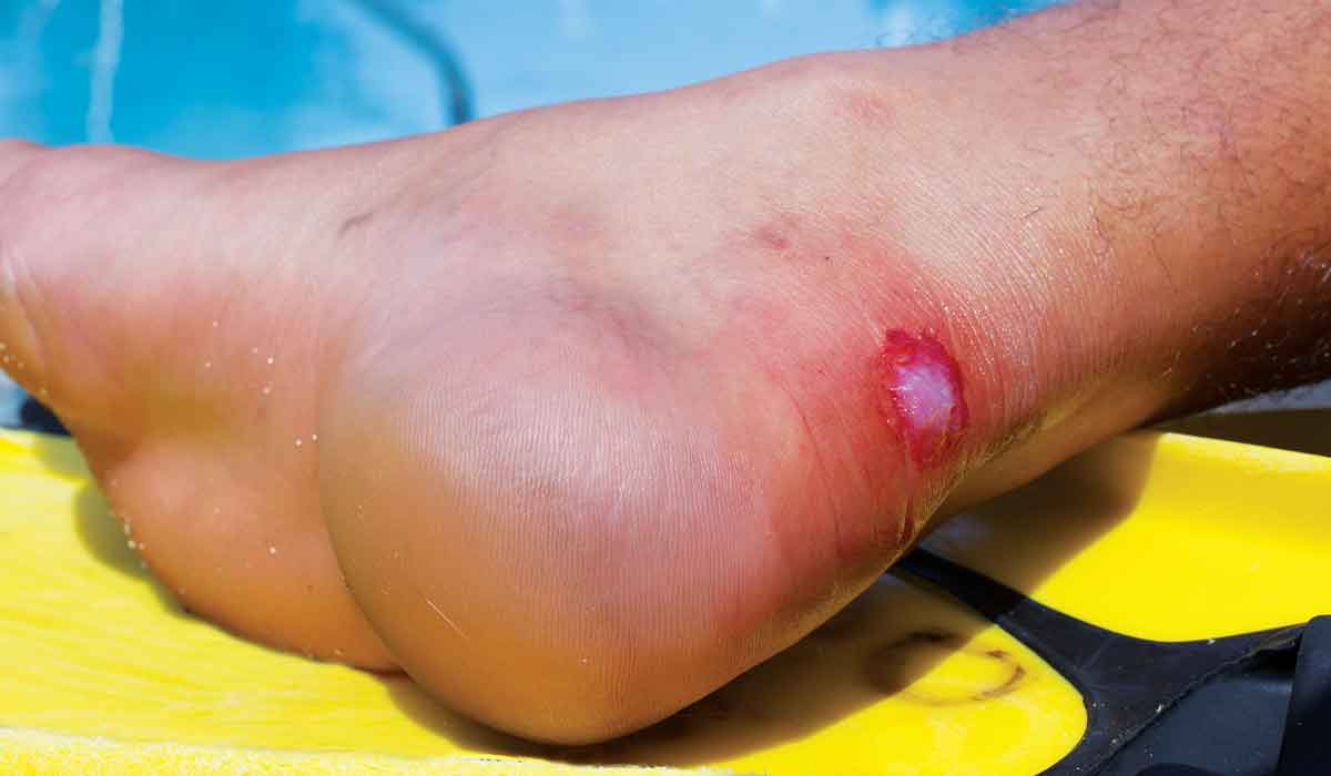 A blister has formed on the back of a person's right ankle