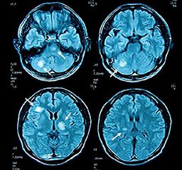 MRI scan shows white spots on brain