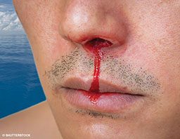 A man with a bit of stubble on his lip and chin has a very bad bloody nose from his left nostril