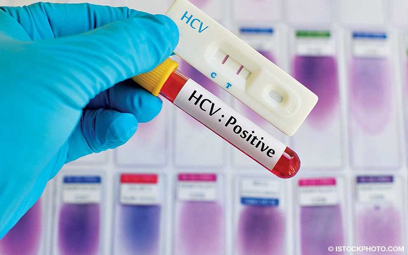 A gloved hand holds up a HCV positive test