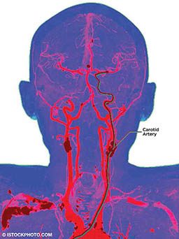 A diagram shows the location of the carotid artery.