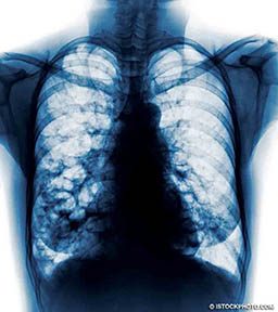 This is an x-ray image of the lungs