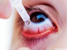 A close-up image of a person putting eye drops into their eyes. 