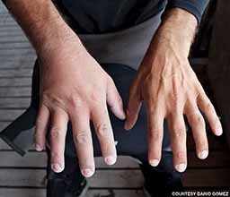 A man shows his swollen hand compared to his non-swollen hand. The right hand is very puffy.