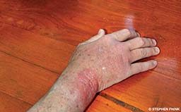 A right hand has a bad rash.