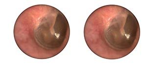 90 Pcs eustachian tube unclogger ear corrector sticker protruding