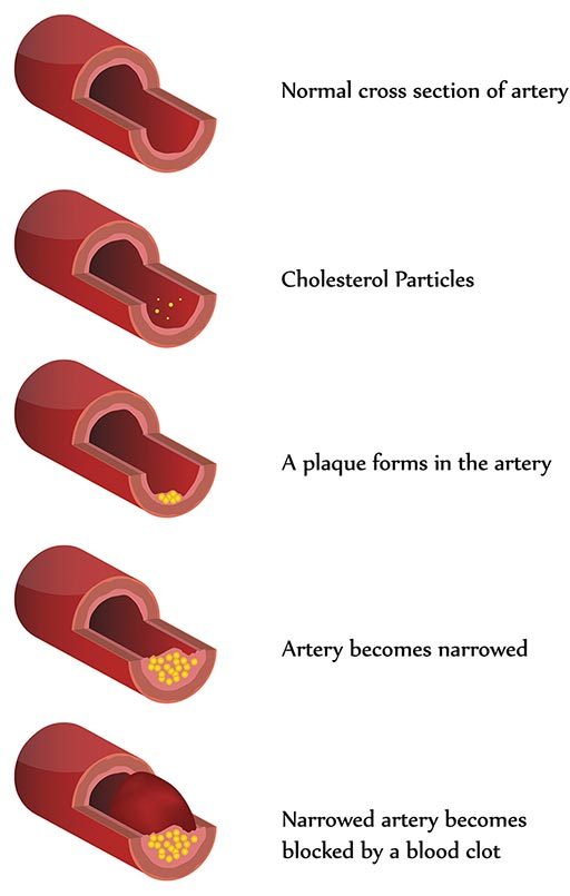 Illustration of the progression of atherosclerosis
