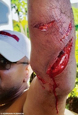 A bloody open wound resulting from a barracuda attack.