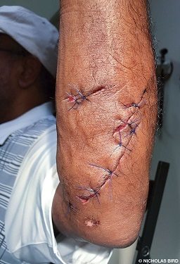 A barracuda bite needed stiches to heal.