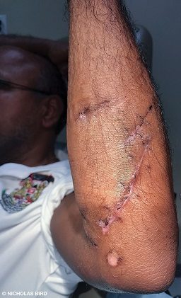 A bad barracuda bite required stitches and is healing. There is a bruise.