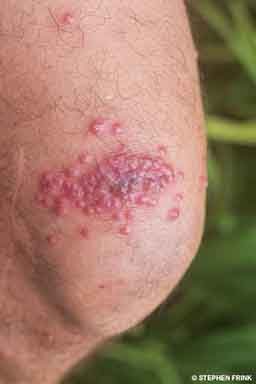 A knee cap has weird red bumps on it. They are the result of a hydroid sting.
