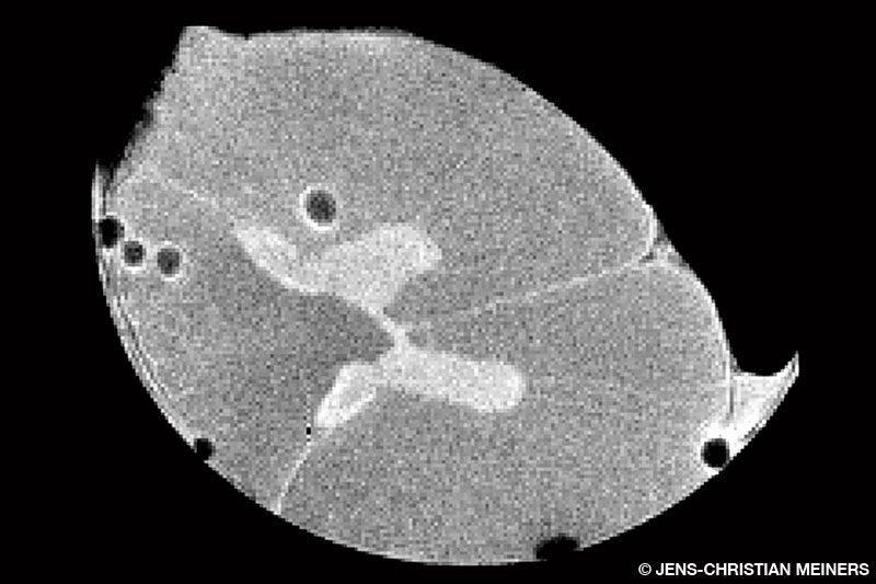 An MRI scan shows gas bubbles