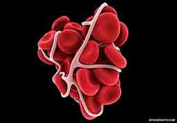 A rendering of what a blood clot could look like