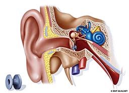 A rendering of the inner ear with an ear grommet