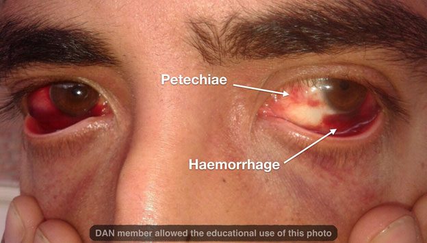 subconjunctival petechiae and hemorrhage from mask barotrauma
