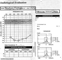 Audiogram test results shows graphs