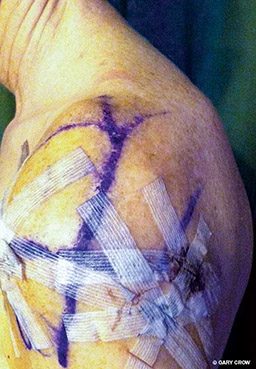 Post-surgery photo of a bandaged shoulder