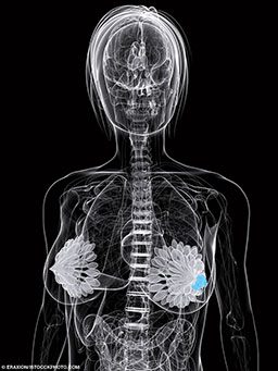 Skeletal illustration of breast cancer