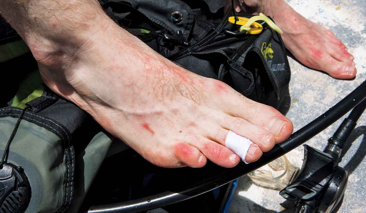 A man's chafed, bandaged, red and irritated feet