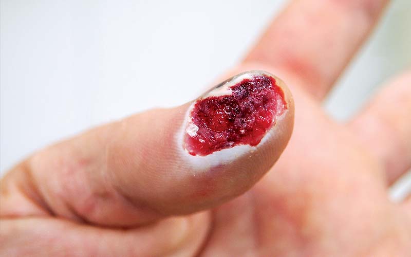 A thumb nail is bloody and completely ripped off