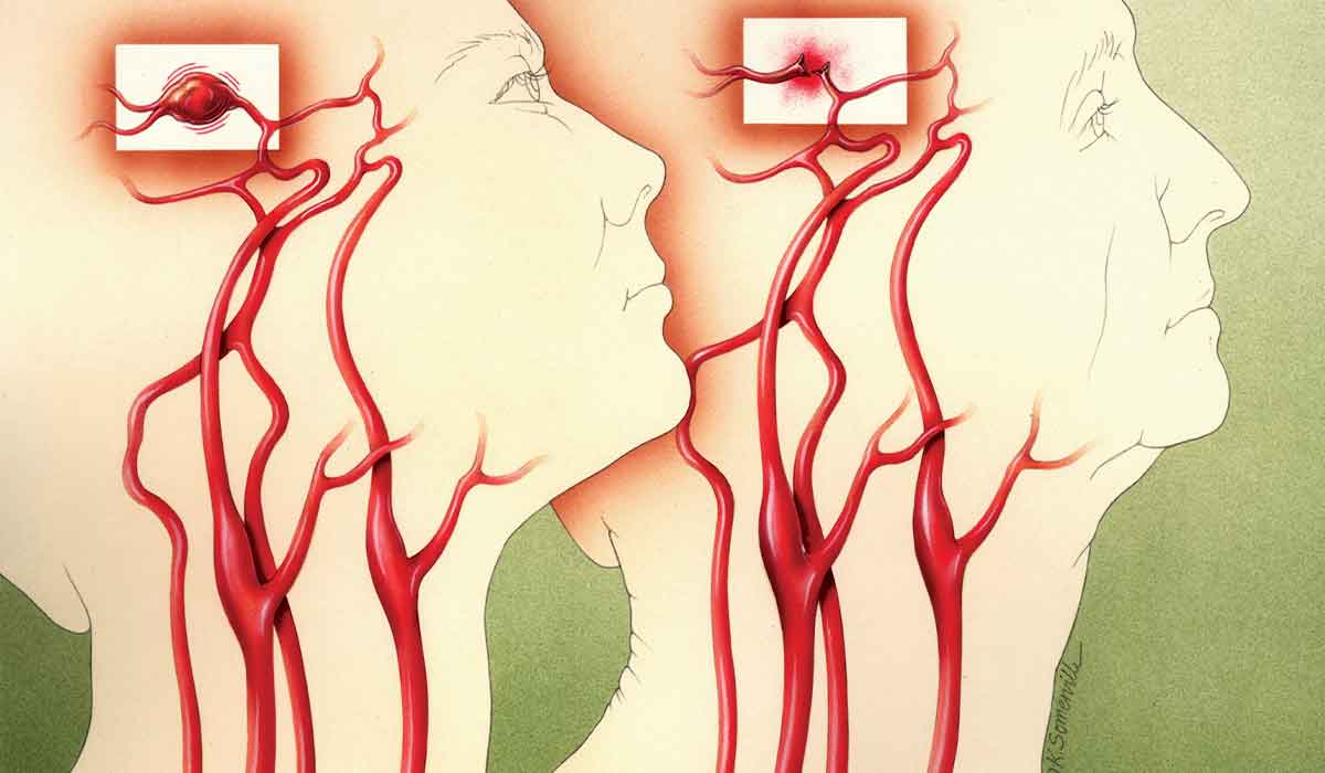 Illustration of two heads showing aneurysms