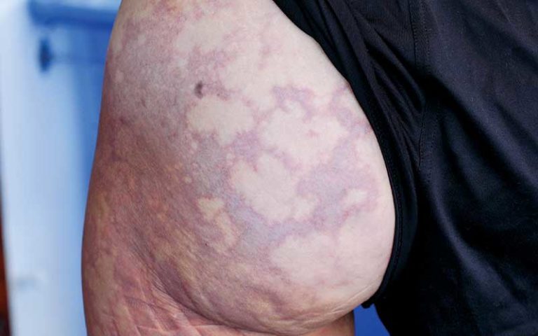 Skin Bends - Divers Alert Network