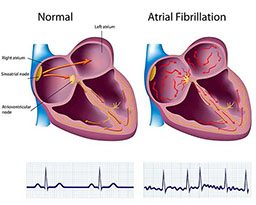 Normal versus atrial fibrillation heart rates