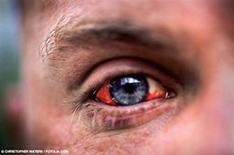 Close-up image of a man's bloodshot left eye