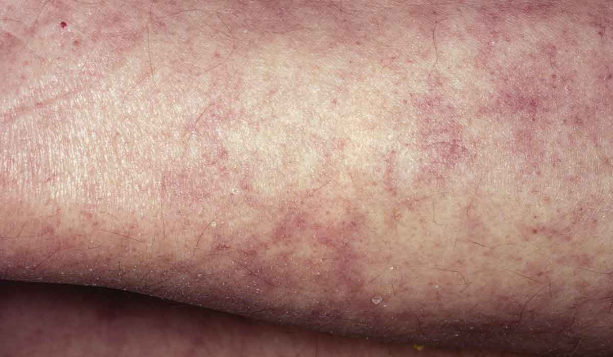 Close-up image of two arms with a rash, or skin bends