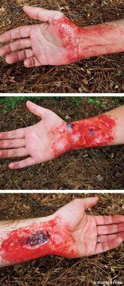 Three images of bloodied and burnt wrist wounds