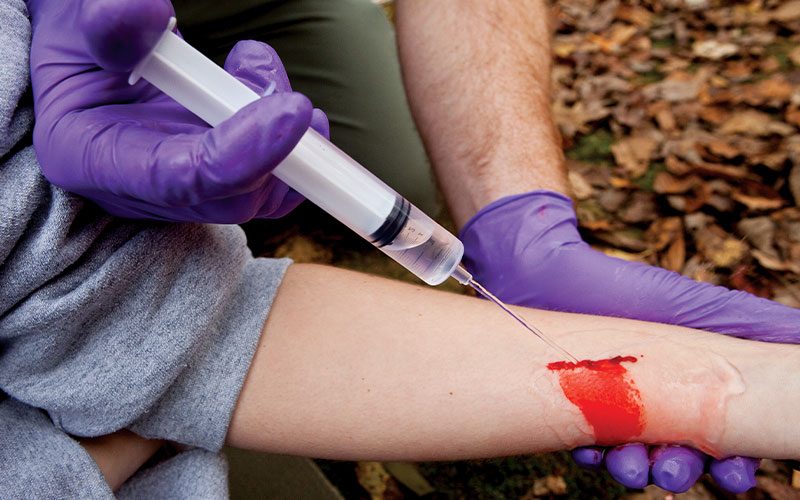 A syringe is used to clean and irrigate a forearm wound