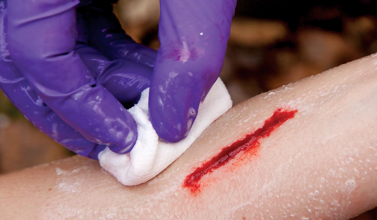 Purple-gloved hand rubs a wound with a white cloth to clean it