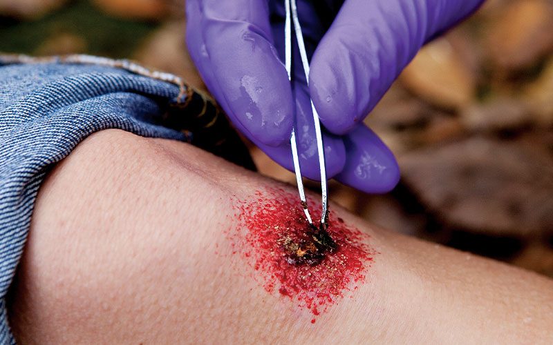 Purple-gloved hand uses tweezers to remove debris from a wound