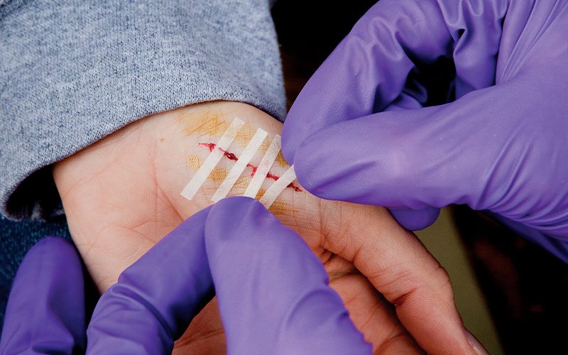 Tiny bandages are used to close a cut