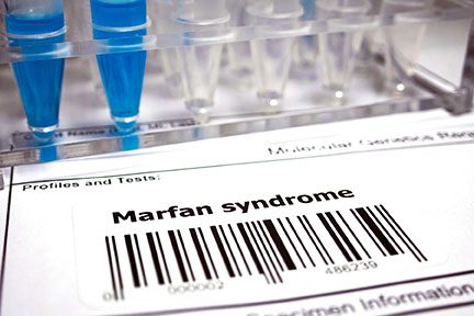 Prueba del síndrome de Marfan