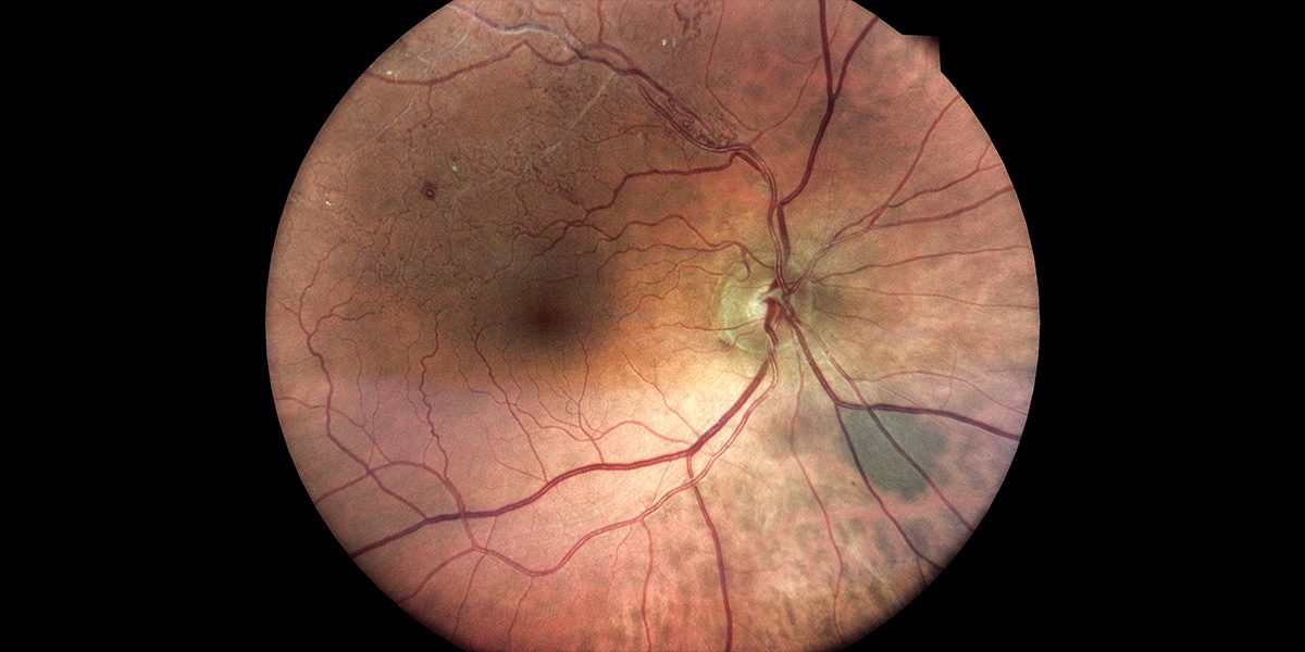 Right Eye Sequelae of Branch retinal artery occlusion (BRAO) located temporal superior