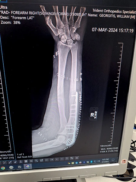 Xray of arm