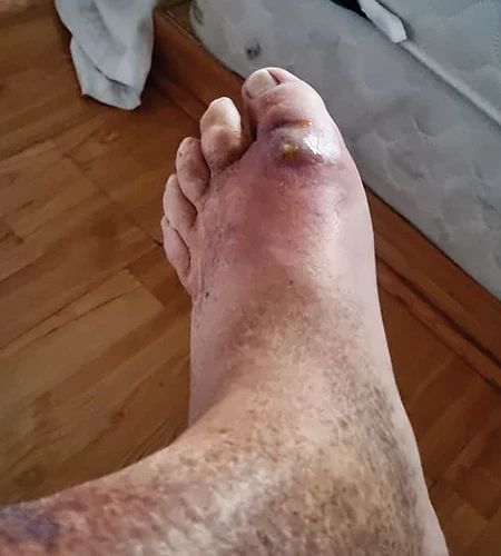 The swelling and pain was incredibly significant from what started as nothing more than a small blister on the author&rsquo;s left big toe