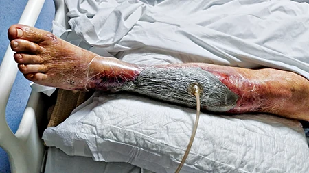 Doctors had to remove a large amount of tissue from his left leg that had necrotized from the bacteria. 