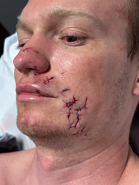 Shark bite showing about 20 teeth marks and 22 inches (56 centimeters) of lacerations on the author’s head and face.