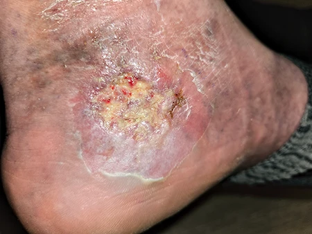 serious Vibrio infection