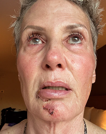 Recovering from facial surgery.