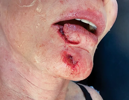 A bonito bite tore through McCombies lower lip and chin.